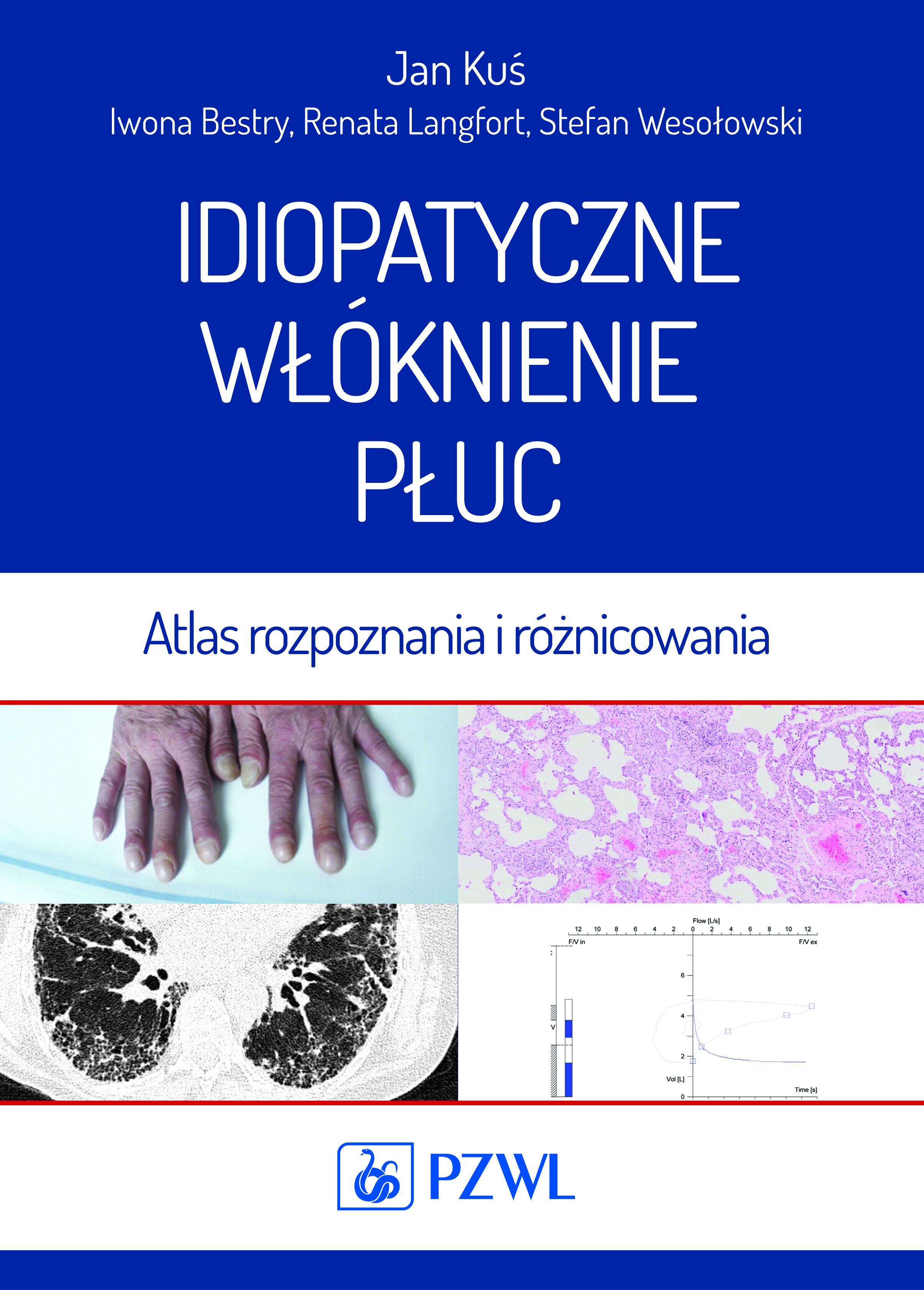 Idiopatyczne włóknienie płuc