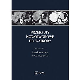 Przerzuty nowotworowe do wątroby